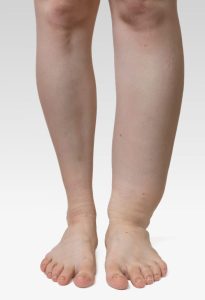 benen-met-oedeem-provitaal-fysiotherapie-meeden-oedeemtherapie