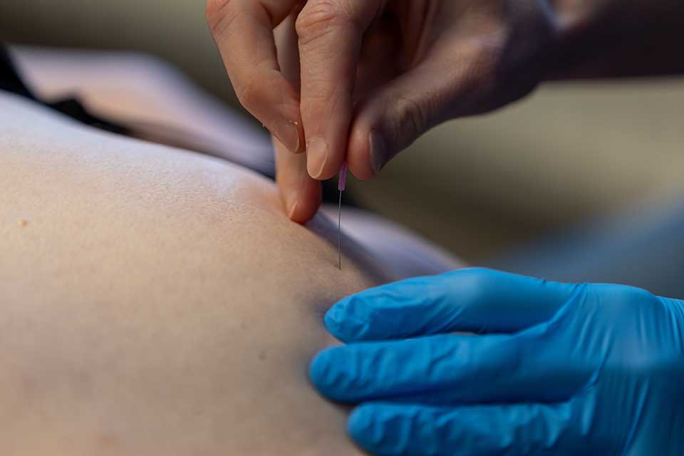Dry-needling_ProVitaal-Meeden_CT-01 Dry-needling_ProVitaal-Meeden_CT-01